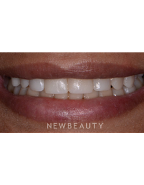 Dr. Irene Grafman - Cosmetic Bonding - After