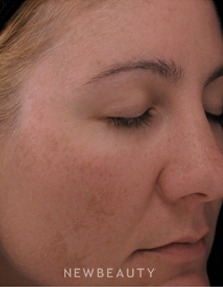 Dr. Kenneth Beer Lasers - Before