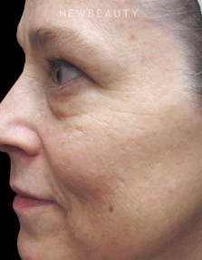 Dr. Jody Levine - Improved Tone and Texture - Before