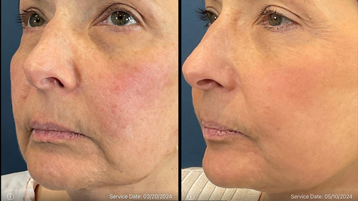 Before and after LaMiNa treatment, two months later, Real Patient Stories, Tatiana Bido