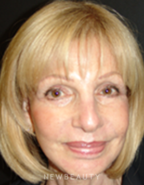 Dr. Mokhtar Asaadi Facelift, Necklift - After