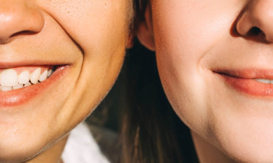 dermelect upper lip lines treatment