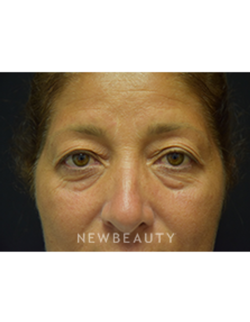 Dr. Jeffrey B. Wise - Eyelift - Before