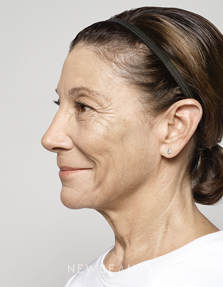 Dr. Ava Shamban - Facial Rejuvenation - Before
