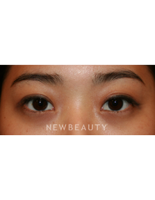 Dr. John Kang - Eyelift - After