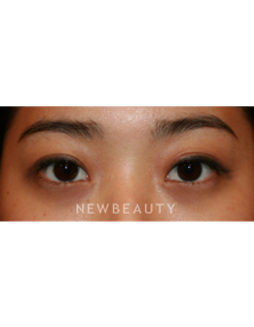 Dr. John Kang - Eyelift - After