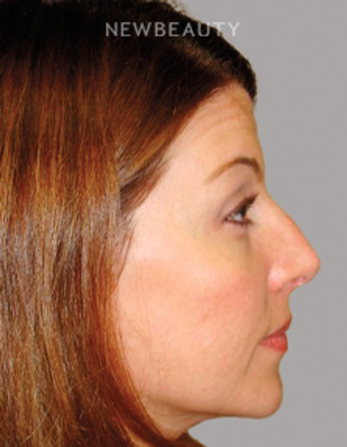 Dr. Sanjay Grover - Rhinoplasty - 49727898 - Before