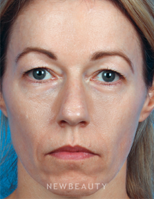 Dr. Kelly Bomer - Upper Blepharoplasty - Before