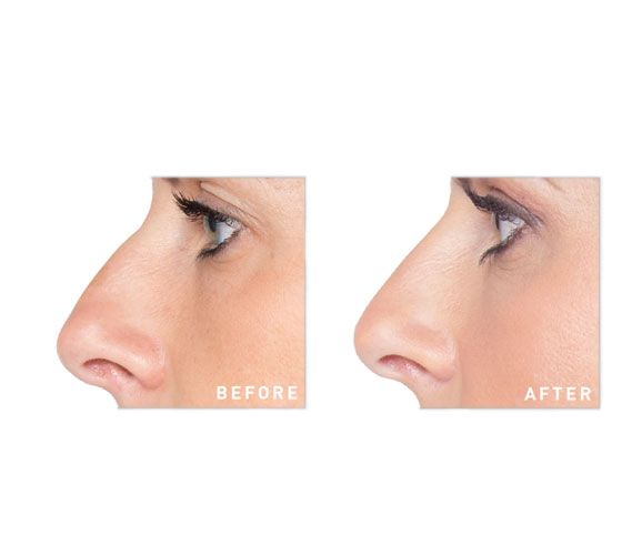 Before and after nonsurgical rhinoplasty