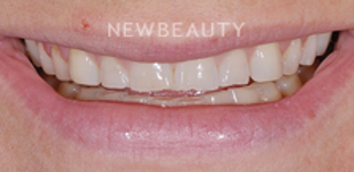 Dr. Salvator La Mastra - Smile Makeover -46107373 - Before