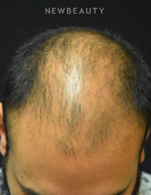 Dr. Jeffrey B. Wise - Hair Transplant for Hair Loss - Before