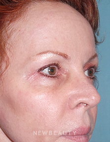 Dr. Sean Simon - Lasers - After