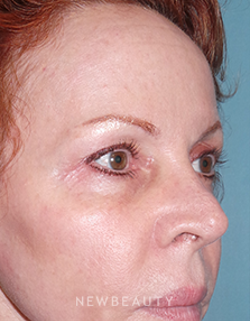 Dr. Sean Simon - Lasers - After