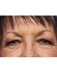 Dr. Kelly Bomer - Upper Blepharoplasty - Before