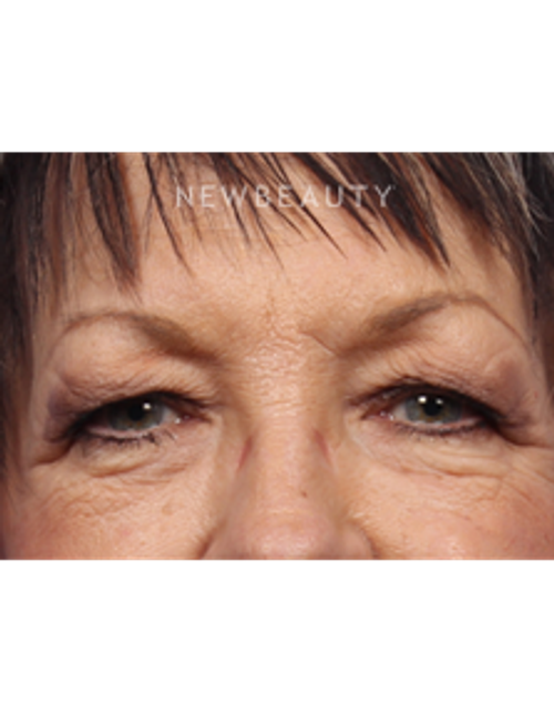 Dr. Kelly Bomer - Upper Blepharoplasty - Before