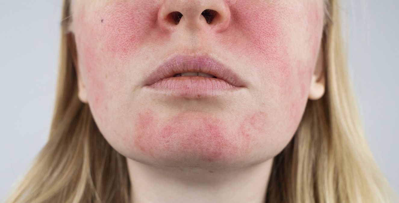 Rosacea-Sufferers Can Now Look for a Seal to Help Buy Products