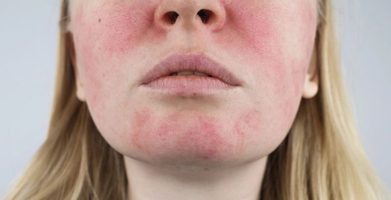 Rosacea-Sufferers Can Now Look for a Seal to Help Buy Products