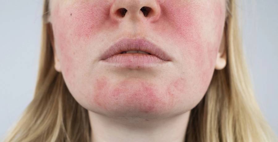 Rosacea-Sufferers Can Now Look for a Seal to Help Buy Products