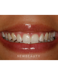 Dr. Patrick Broome - Gum Lift - Before