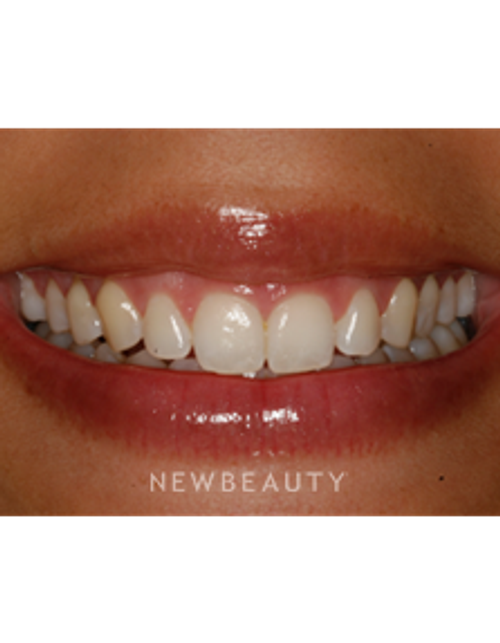 Dr. Patrick Broome - Gum Lift - Before