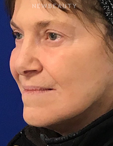 Dr. Dilip D. Madnani – Facelift - After