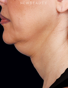 Dr. Ava Shamban - Injectables & Fillers - Before