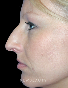 Dr. Kelly Bomer - Rhinoplasty - Before