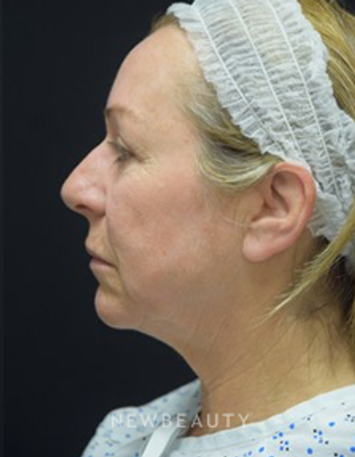Dr. Jeffrey B. Wise - Facelift - Before