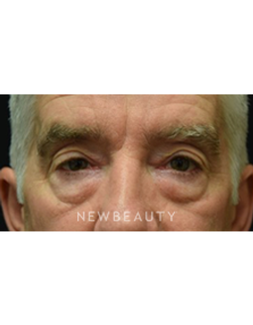 Dr. Jeffrey B. Wise - Eyelift - Before