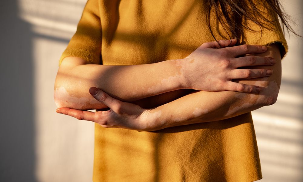 Close up of an unrecognizable Caucasian woman showing vitiligo, rare skin condition on her hands