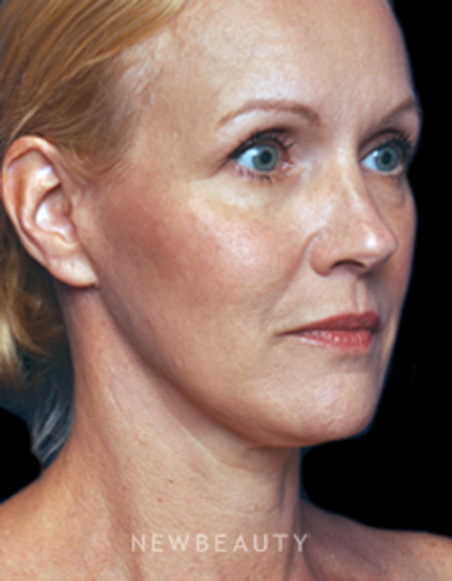 Dr. Alan J. Durkin - Facial Rejuvenation - After