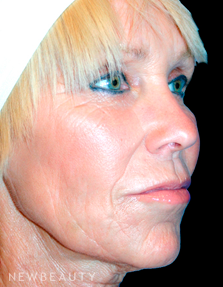 Dr. Kelly Bomer Facelift - After