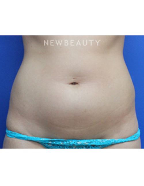 Dr. Joseph Russo - Sculpted Silhouette - Before