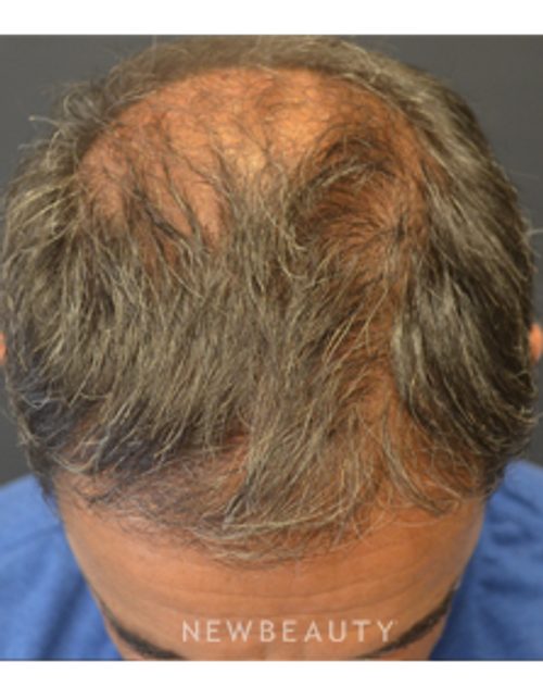Drs. Lieberman & Parikh - Hair Restoration - After