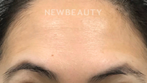 Dr. Elaine Kung - Wrinkle Relaxer - 33036784 - After