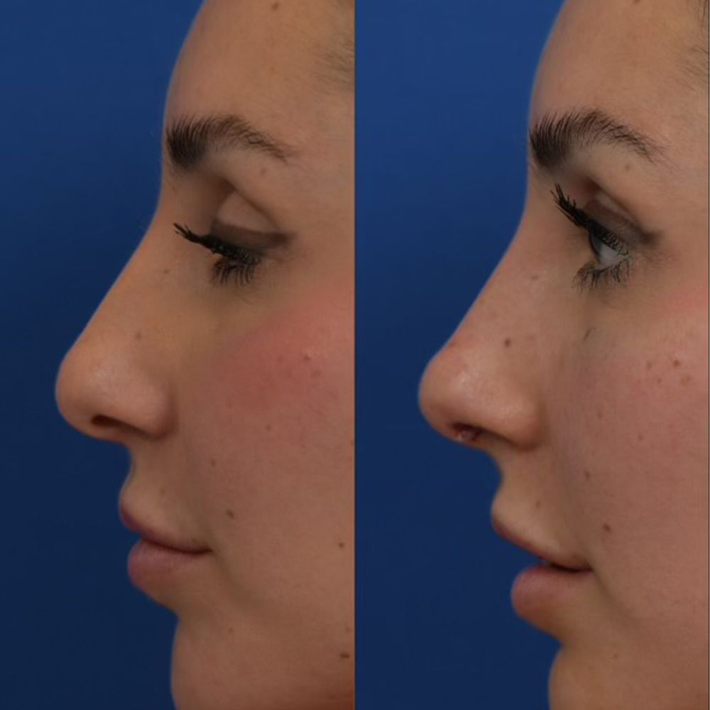 tip stitch before and after