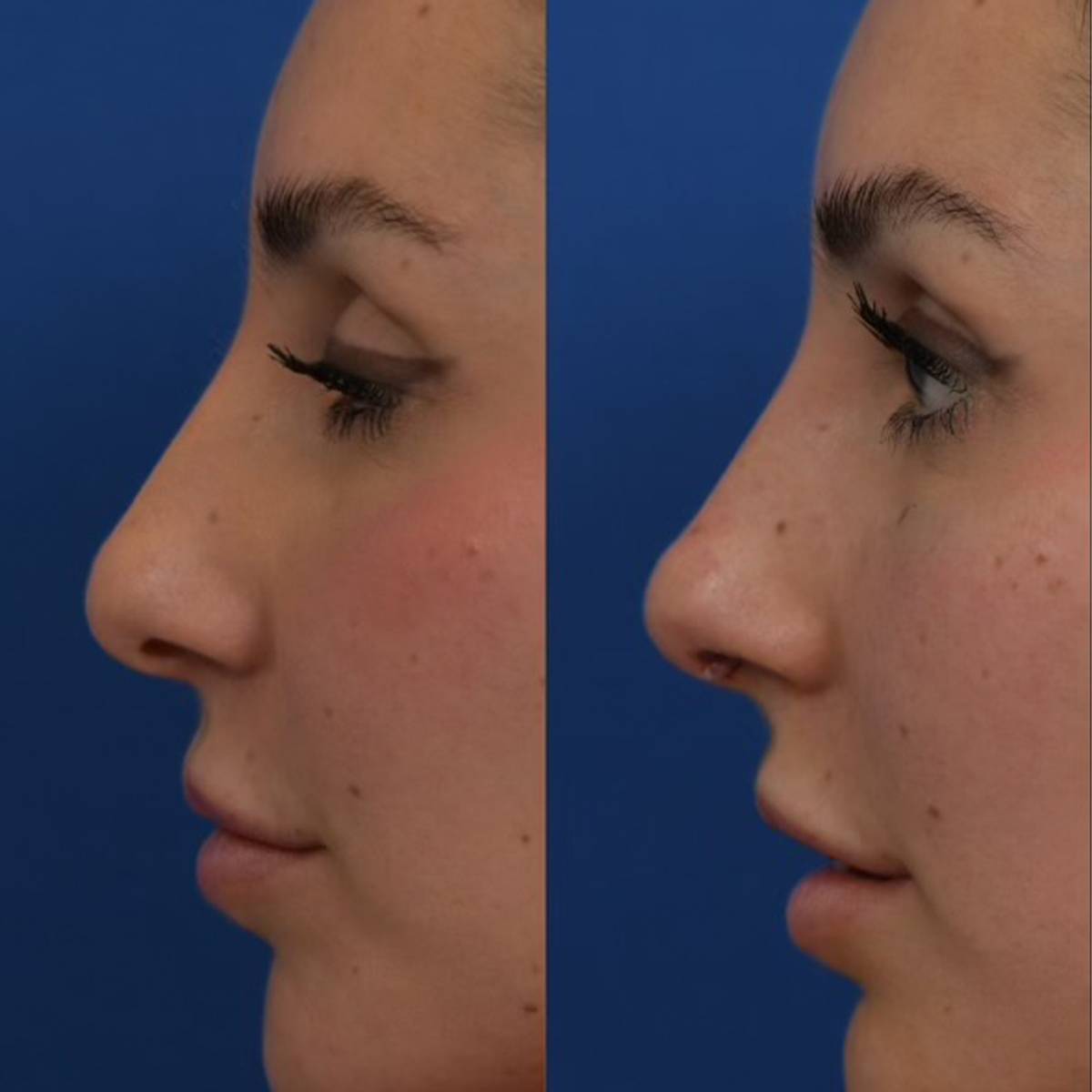 tip stitch before and after