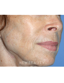 Dr Kelly Bomer Injectable Fillers - Before