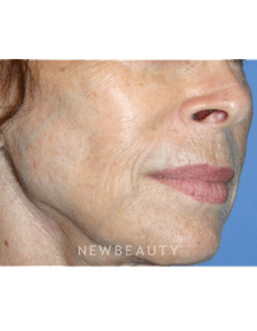 Dr Kelly Bomer Injectable Fillers - Before