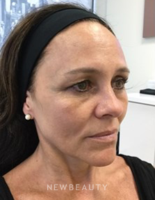 Dr. Julie Russak - Liquid Facelift - Before