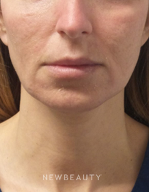 Dr. Marina Peredo - Juvéderm Vollure - Before