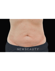 Dr. Julie Russack Fat Melters - After