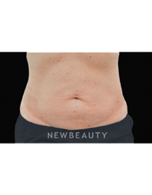 Dr. Julie Russack Fat Melters - After