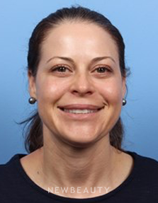 Dr. Kelly Bomer - Dysport - After