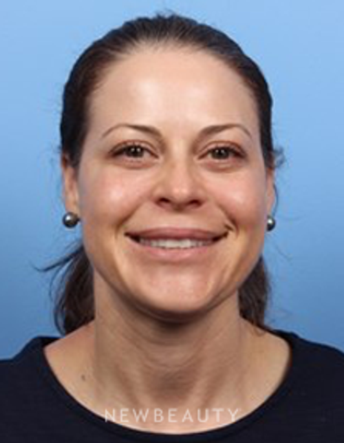 Dr. Kelly Bomer - Dysport - After