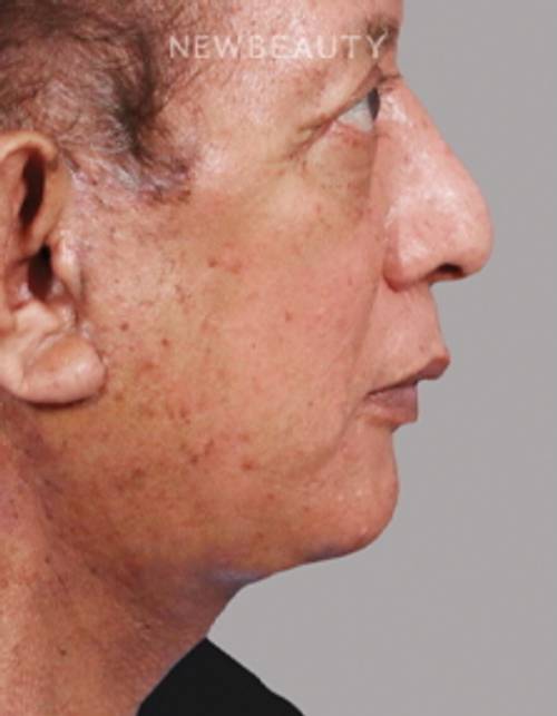 Dr. Paul Nassif - Facelift &Necklift - 51351682 - After