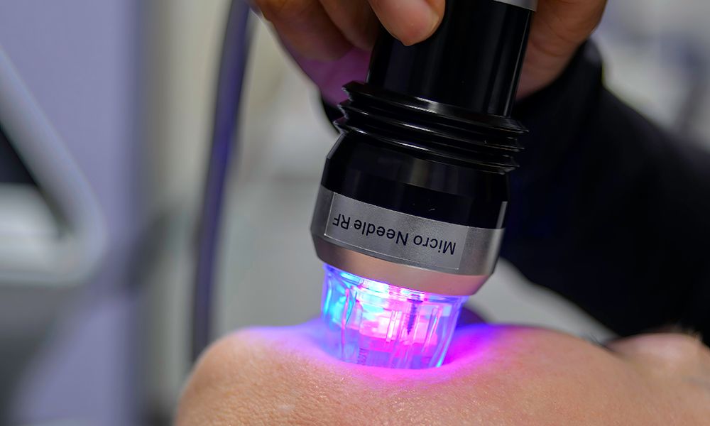 A patient has an RF microneedling procedure performed on her face. When inserted into the skin the needles emit radio frequency energy that causes the skin to tighten.