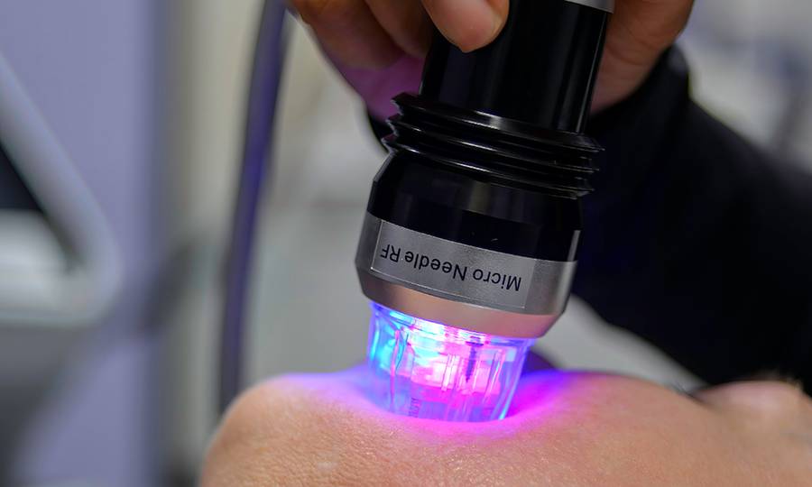 A patient has an RF microneedling procedure performed on her face. When inserted into the skin the needles emit radio frequency energy that causes the skin to tighten.