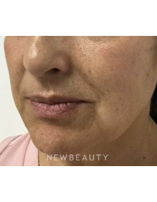 Dr. Julie Russak - Lower Facelift - After