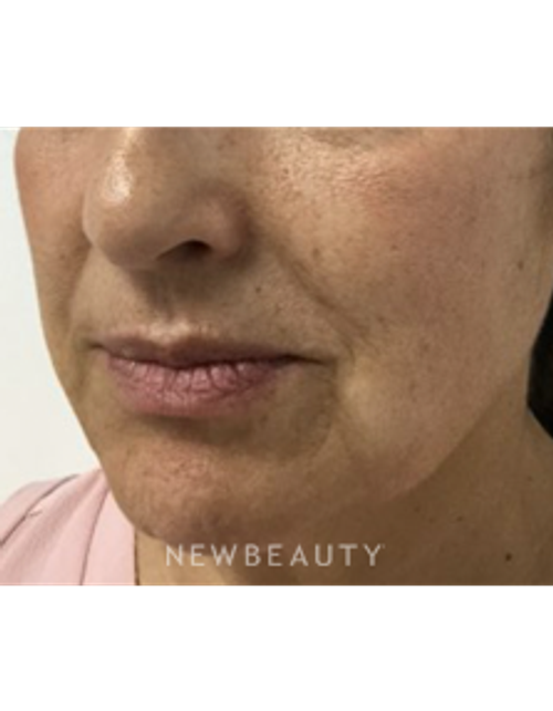 Dr. Julie Russak - Lower Facelift - After